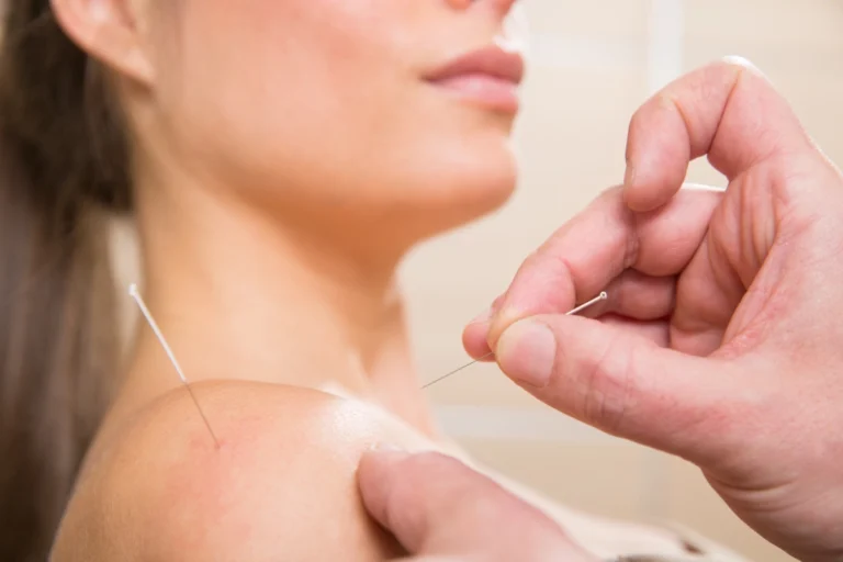 dry needling physio Melbourne